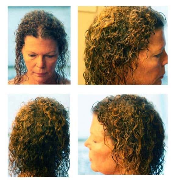 After XTC Hair Boost System & Xtreme Laser Treatment Nashville Trichology Center